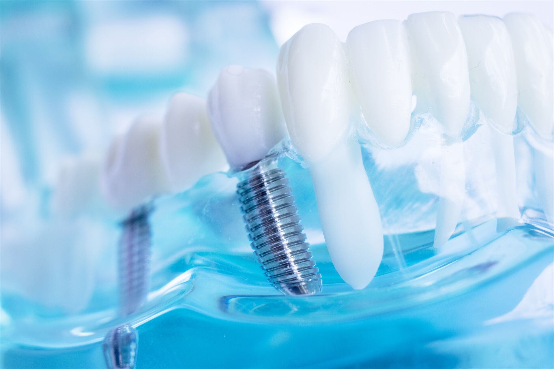 インプラント